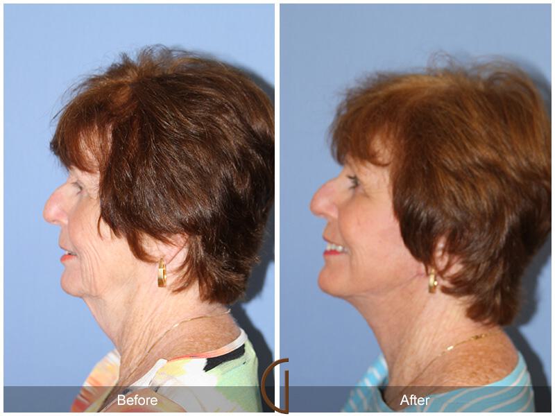 Facelift Seventies  Before & After Photo