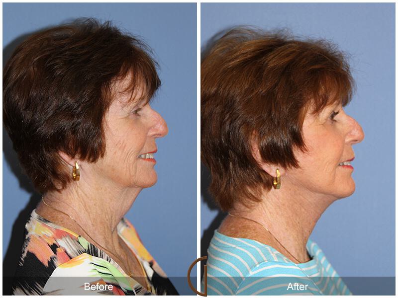 Facelift Seventies  Before & After Photo