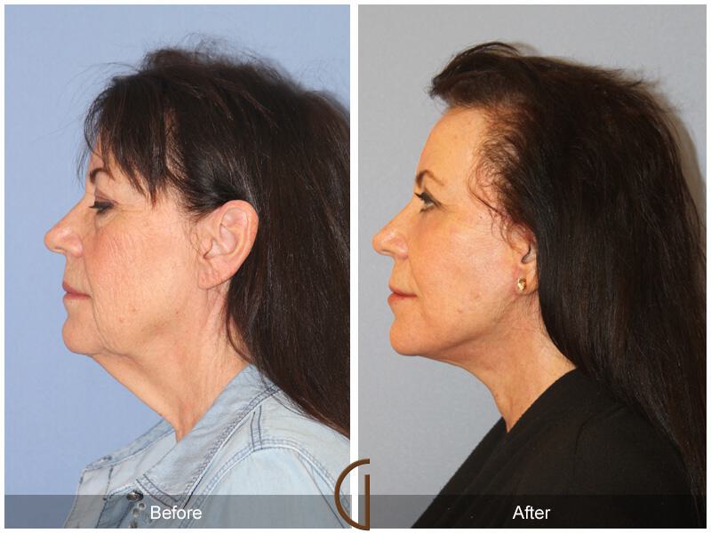 Facelift Seventies  Before & After Photo