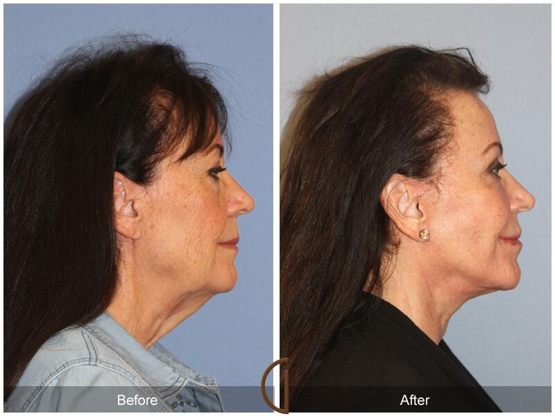 Facelift Seventies  Before & After Photo