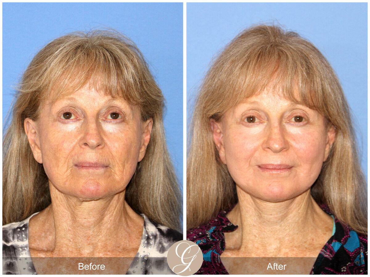 Facelift Seventies  Before & After Photo