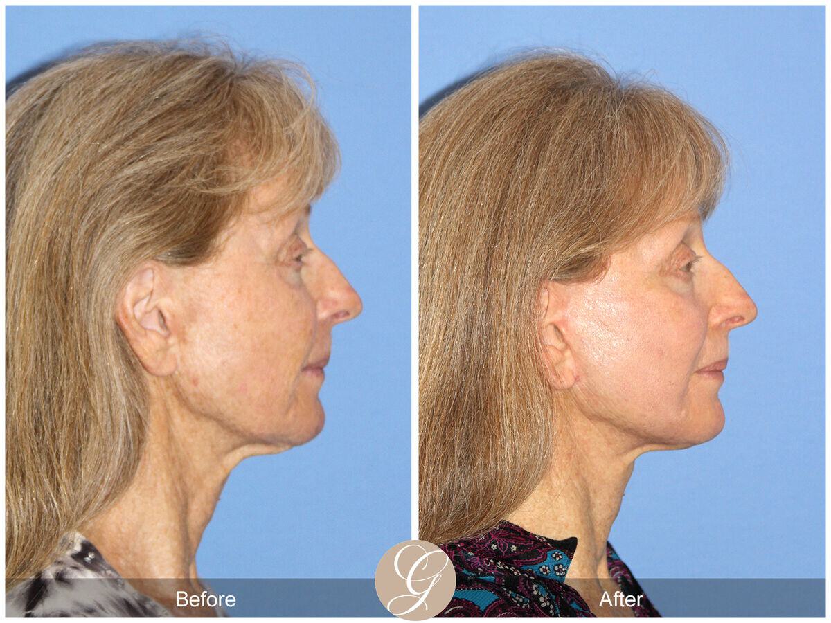 Facelift Seventies  Before & After Photo