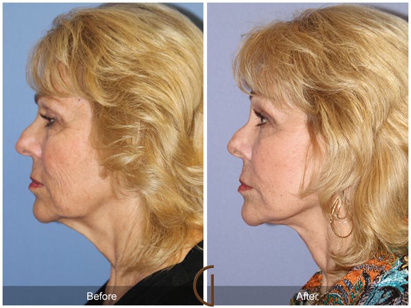 Facelift Seventies  Before & After Photo