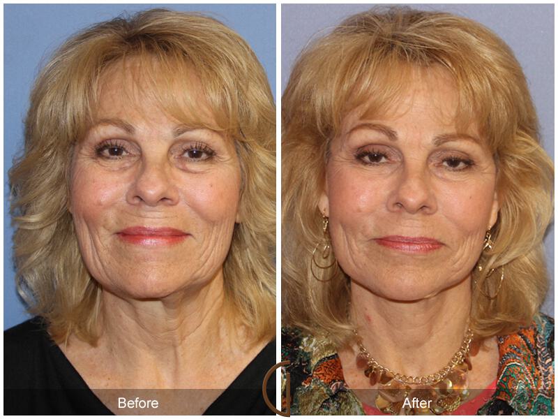 Facelift Seventies  Before & After Photo