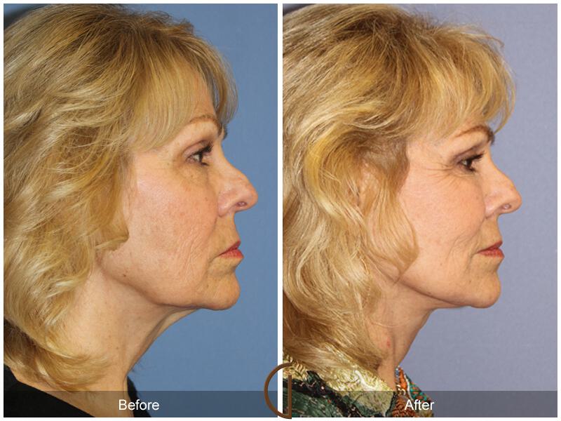 Facelift Seventies  Before & After Photo