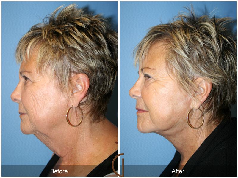 Facelift Seventies  Before & After Photo