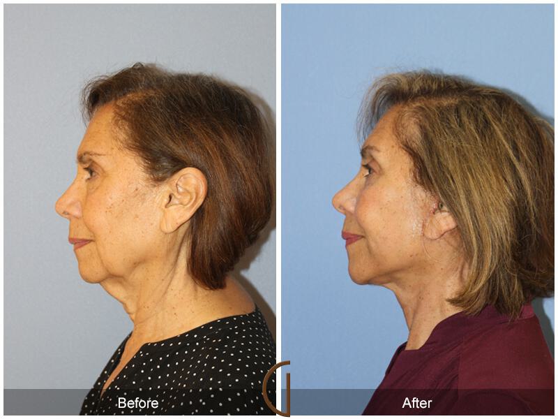 Facelift Seventies  Before & After Photo