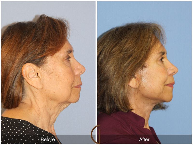 Facelift Seventies  Before & After Photo