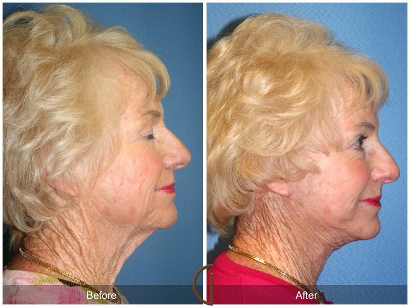 Facelift Seventies  Before & After Photo