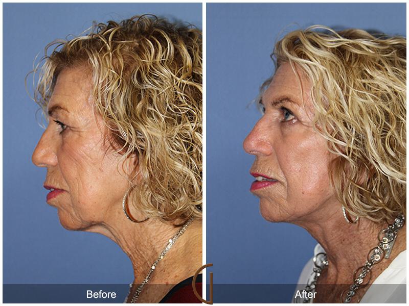 Facelift Seventies  Before & After Photo