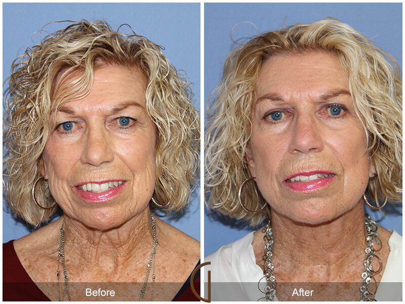 Facelift Seventies  Before & After Photo