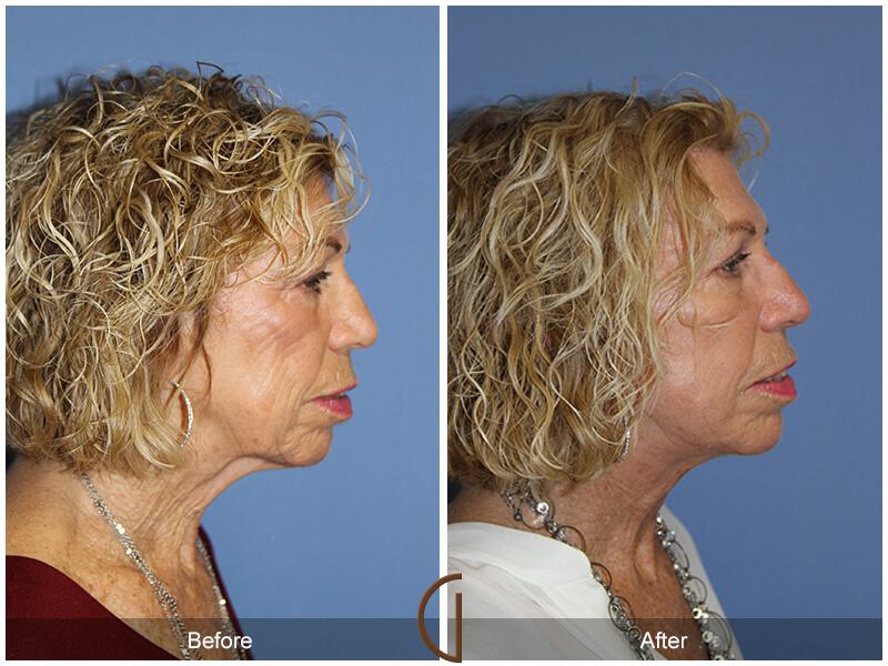 Facelift Seventies  Before & After Photo