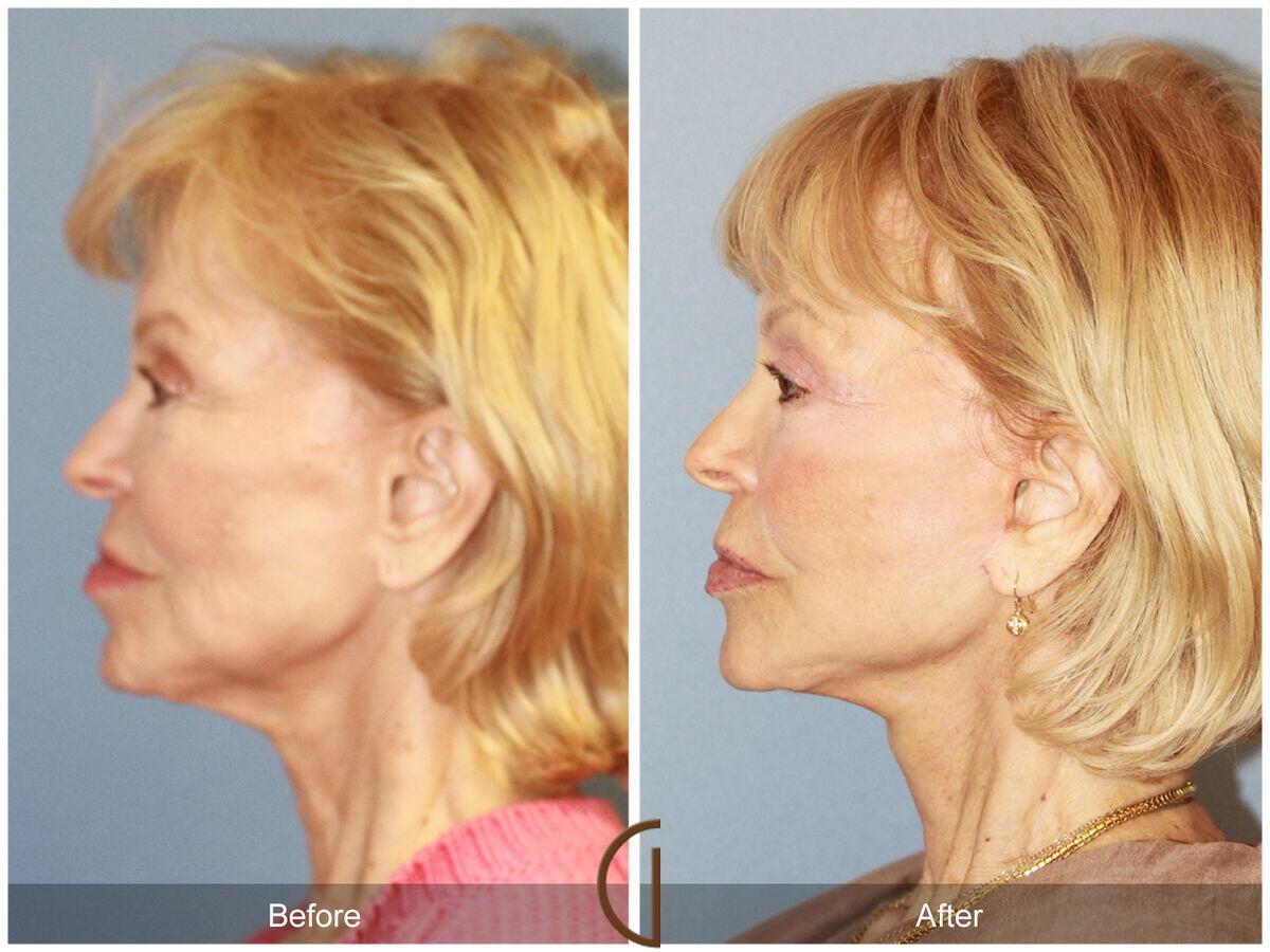 Facelift Seventies  Before & After Photo