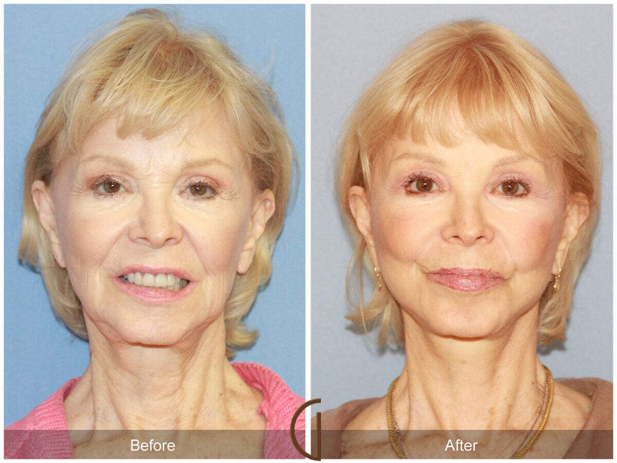 Facelift Seventies  Before & After Photo