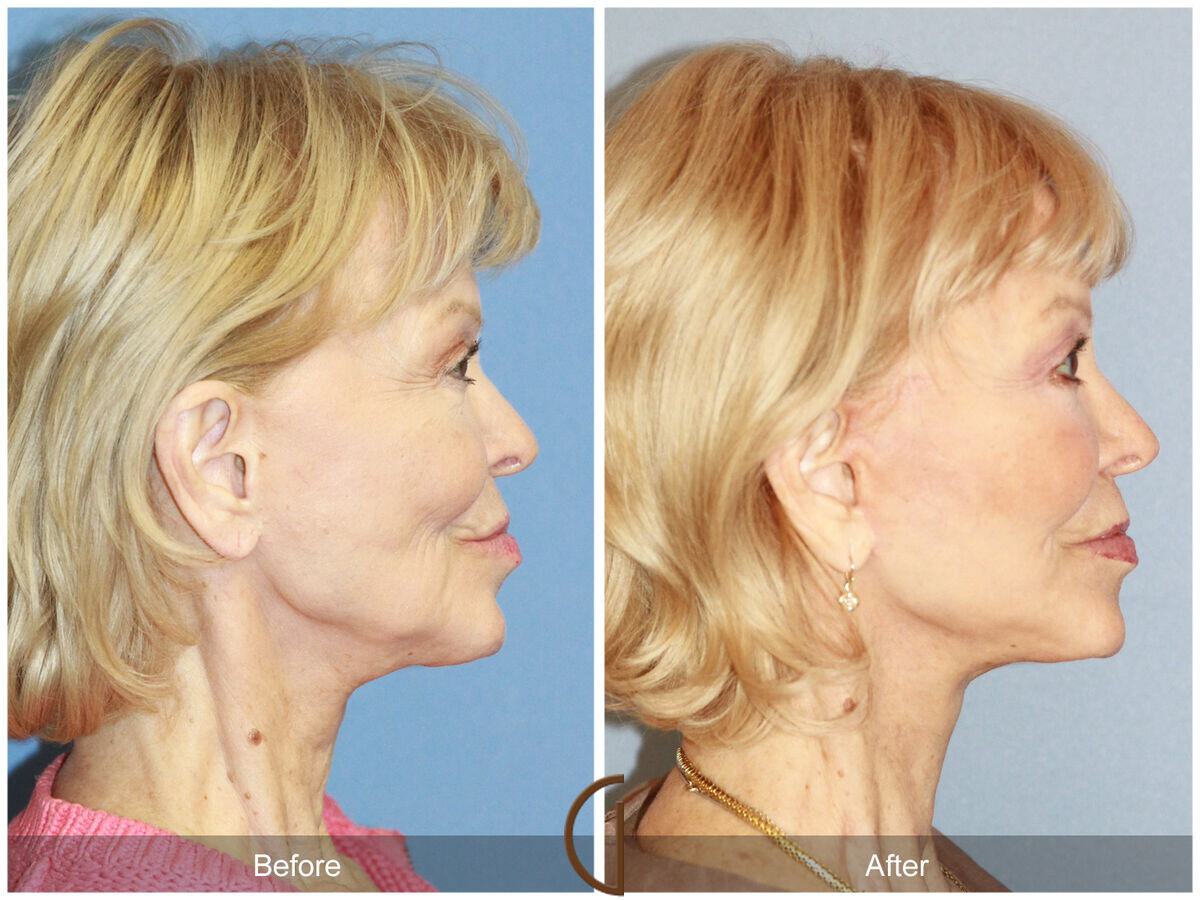 Facelift Seventies  Before & After Photo