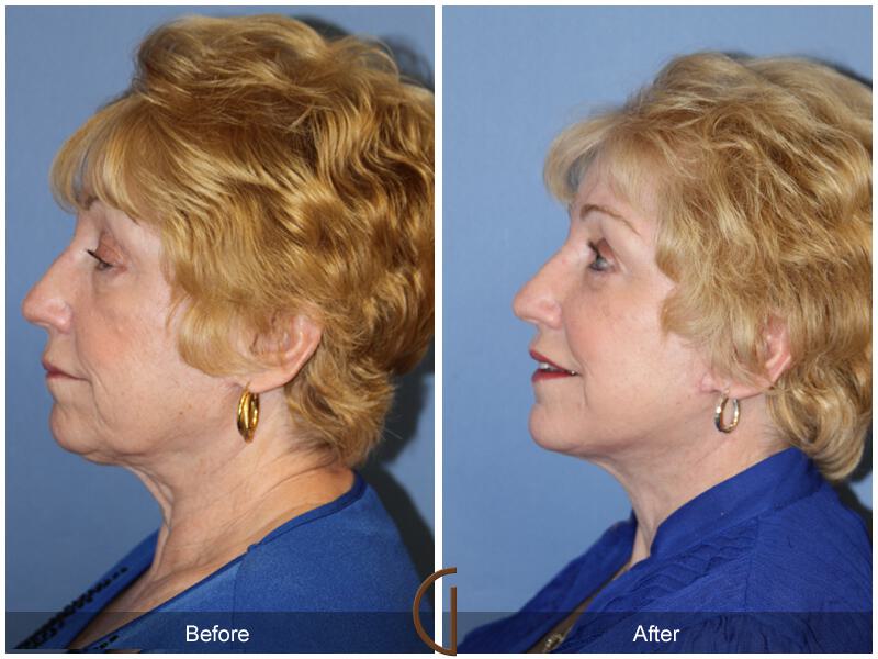 Facelift Seventies  Before & After Photo