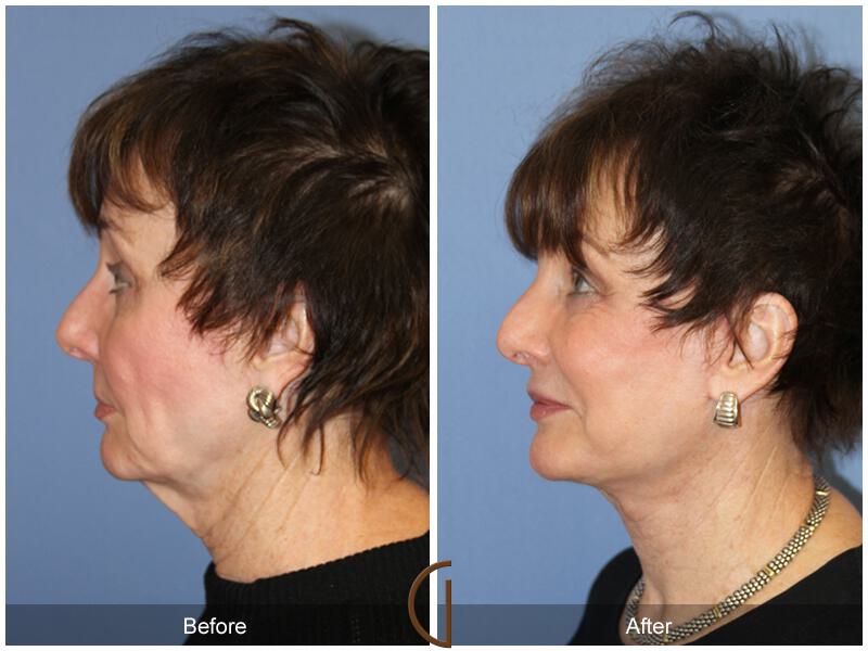 Facelift Seventies  Before & After Photo