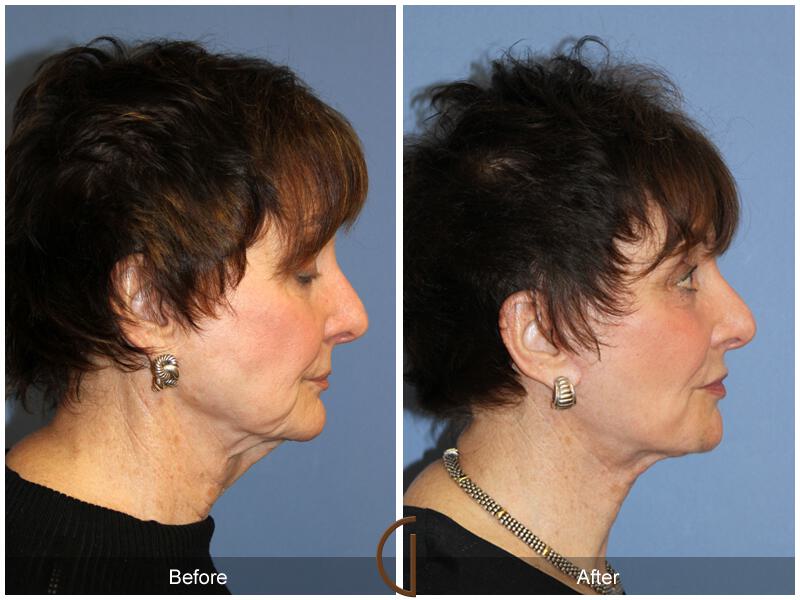 Facelift Seventies  Before & After Photo