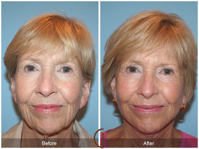 Facelift Seventies  Before & After Photo