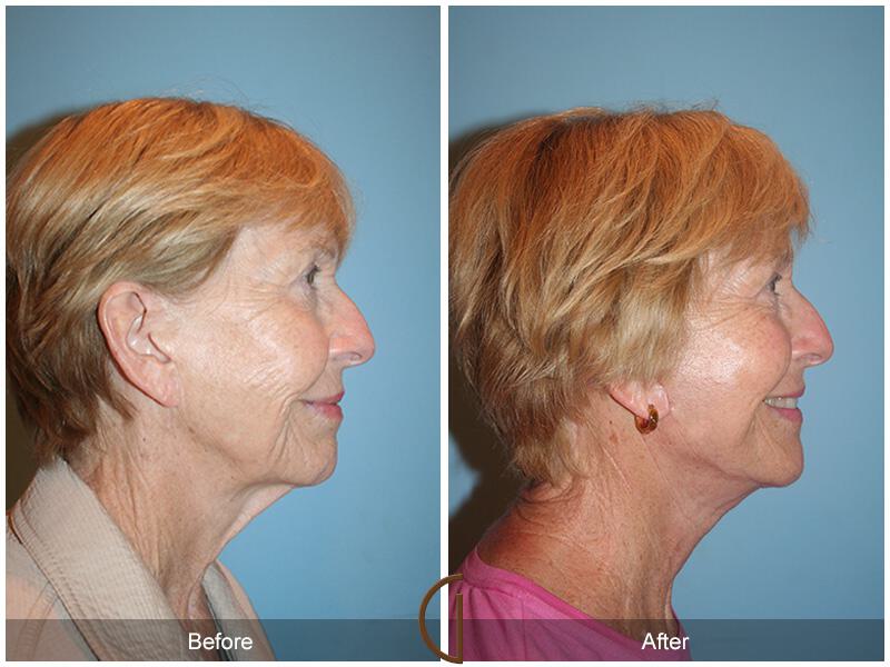 Facelift Seventies  Before & After Photo