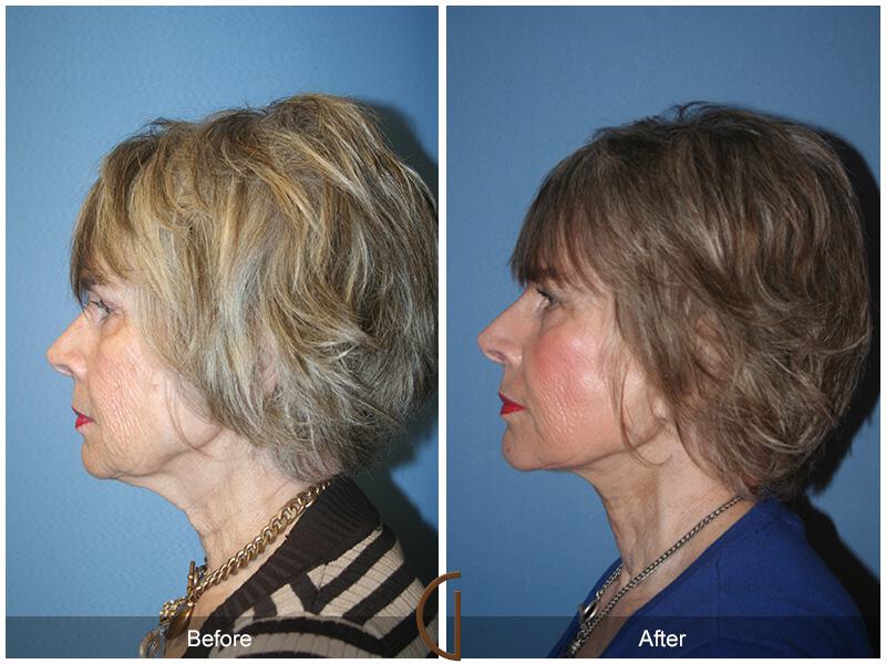 Facelift Seventies  Before & After Photo