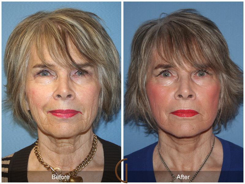 Facelift Seventies  Before & After Photo