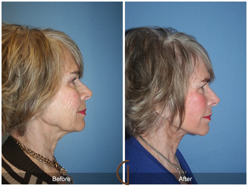 Facelift Seventies  Before & After Photo