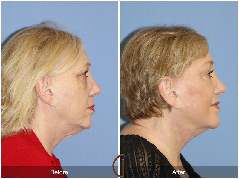 Facelift Seventies  Before & After Photo