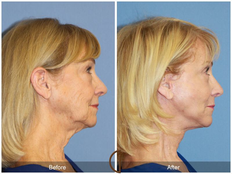 Facelift Seventies  Before & After Photo