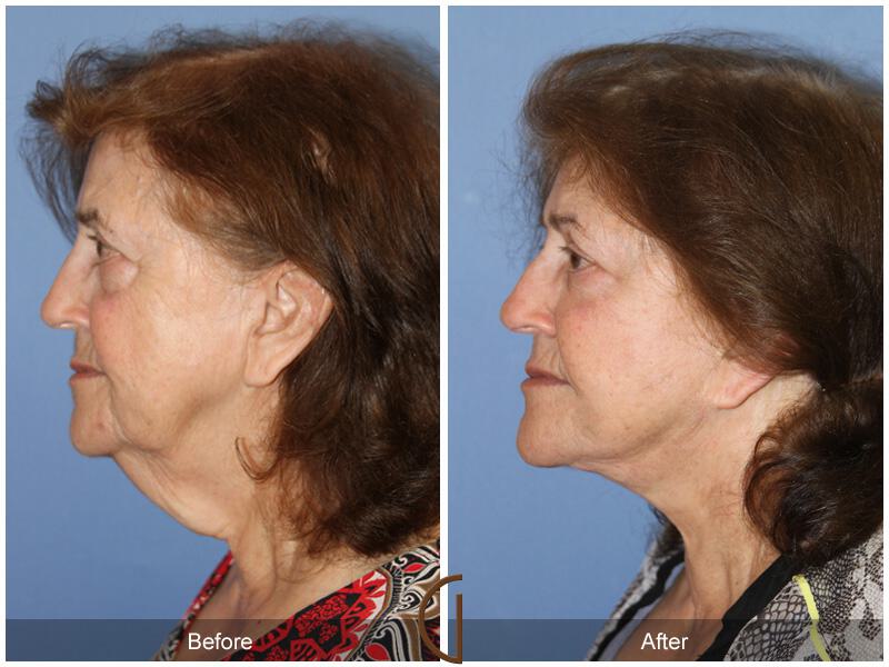 Facelift Seventies  Before & After Photo