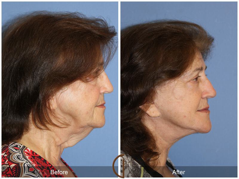 Facelift Seventies  Before & After Photo