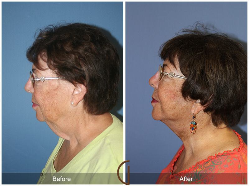 Facelift Seventies  Before & After Photo