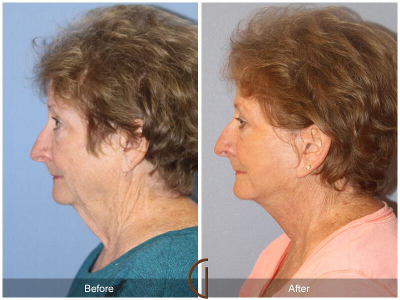 Facelift Seventies  Before & After Photo