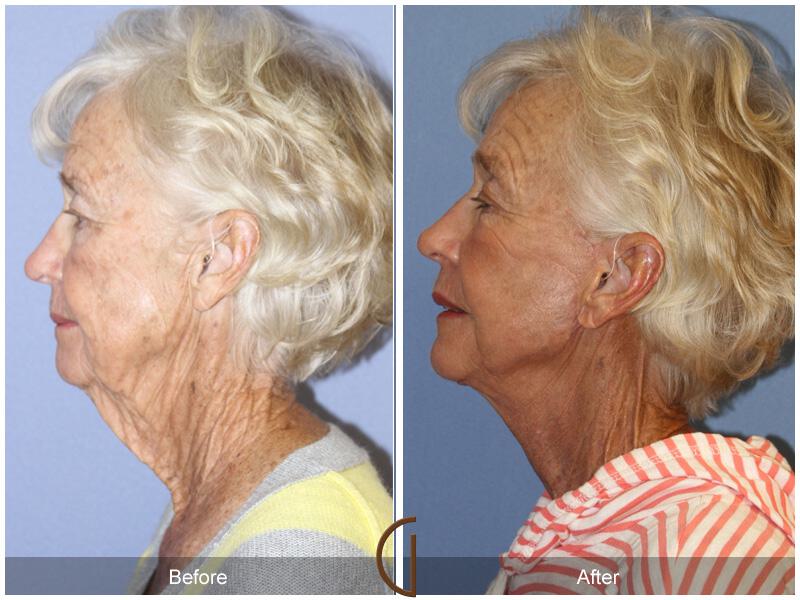 Facelift Seventies  Before & After Photo