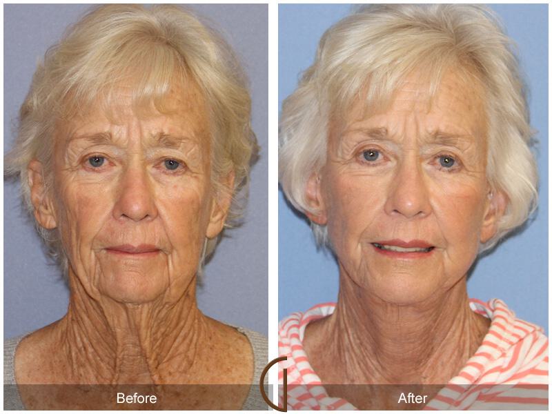 Facelift Seventies  Before & After Photo