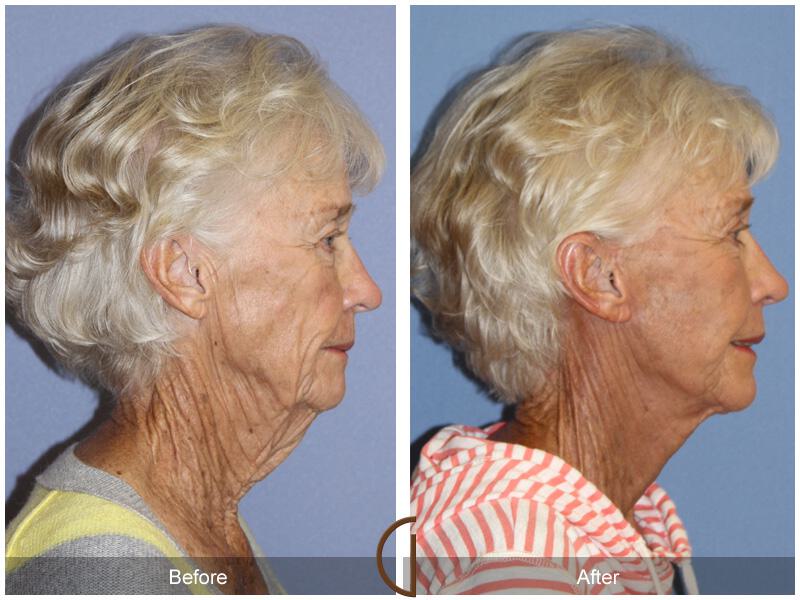 Facelift Seventies  Before & After Photo