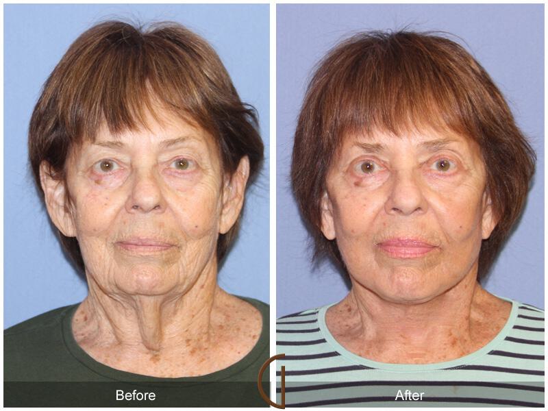 Facelift After Weight Loss Before & After Photo