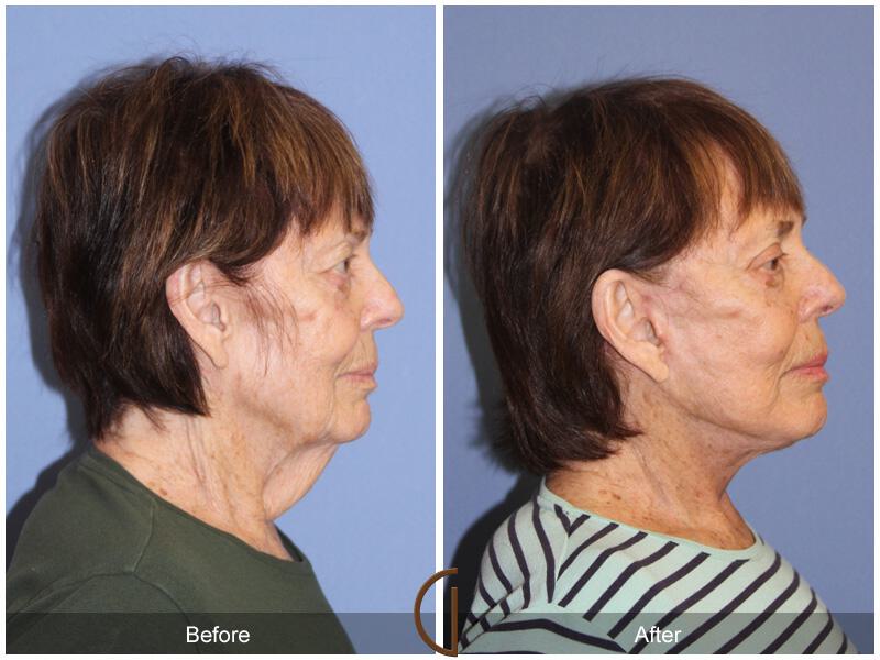 Facelift After Weight Loss Before & After Photo