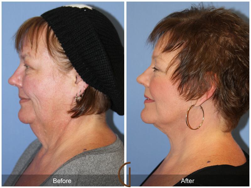 Facelift After Weight Loss Before & After Photo