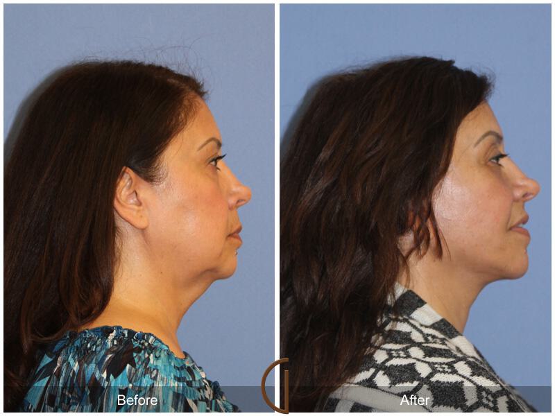 Facelift Ethnic Before & After Photo