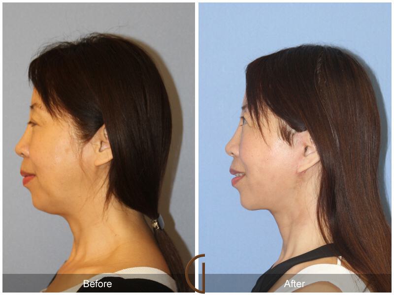 Facelift Ethnic Before & After Photo