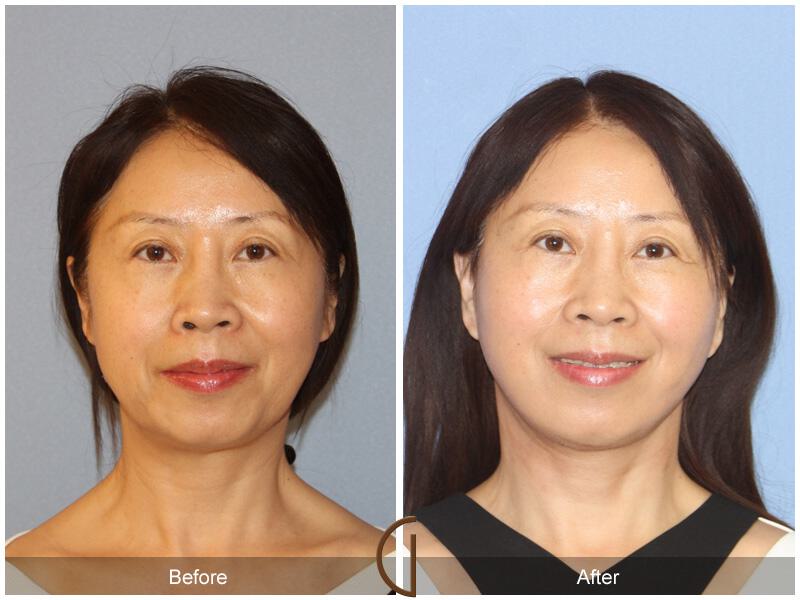 Facelift Ethnic Before & After Photo