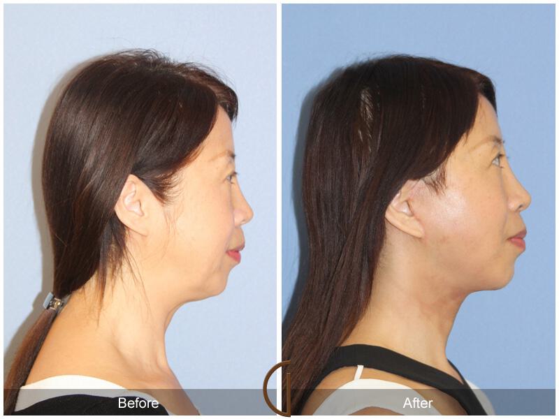 Facelift Ethnic Before & After Photo