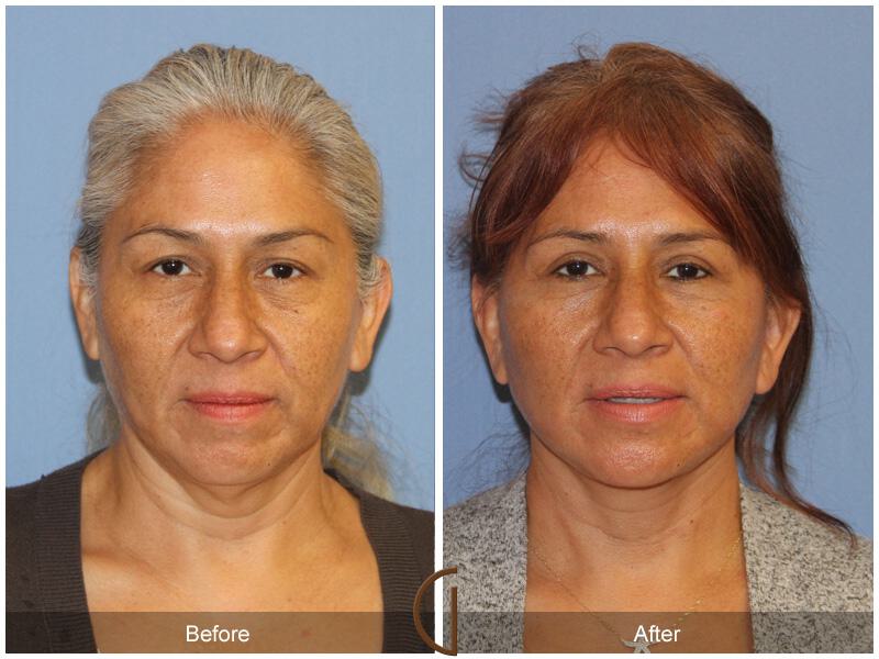 Facelift Ethnic Before & After Photo