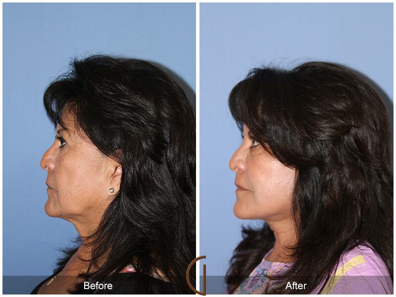 Facelift Ethnic Before & After Photo