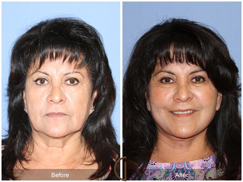 Facelift Ethnic Before & After Photo