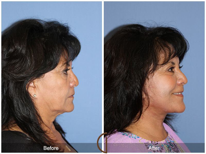 Facelift Ethnic Before & After Photo