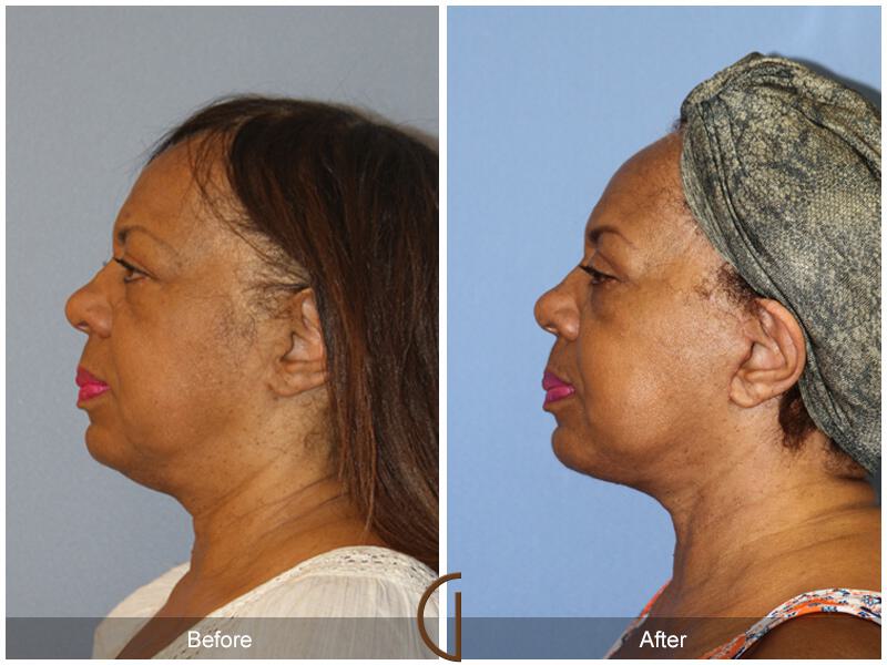 Facelift Ethnic Before & After Photo