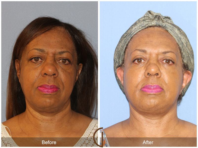 Facelift Ethnic Before & After Photo