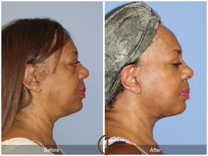 Facelift Ethnic Before & After Photo